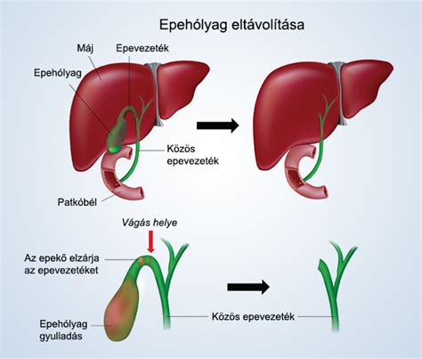 epehólyag egészséges étrend vizuális áttekintése